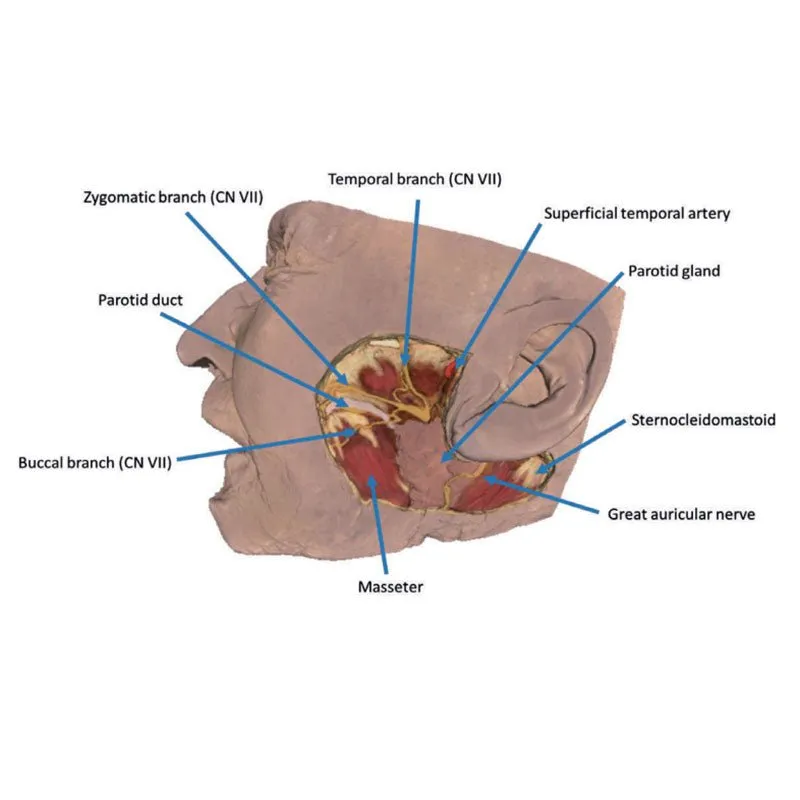 3D Printed Parotid Gland and Facial Nerve Dissection